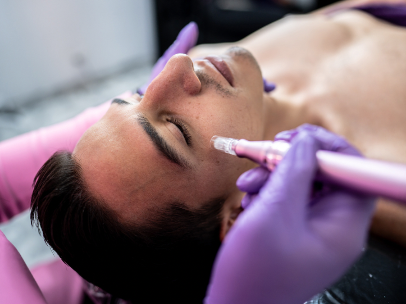 Microneedling_Restorative_You_Spa